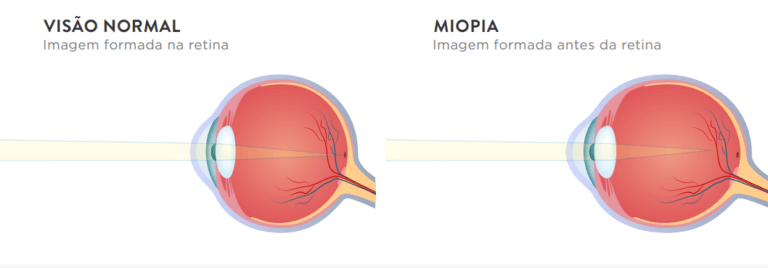 Trei pași pentru a trata natural miopia, Dacă nu vezi în depărtare este miopie
