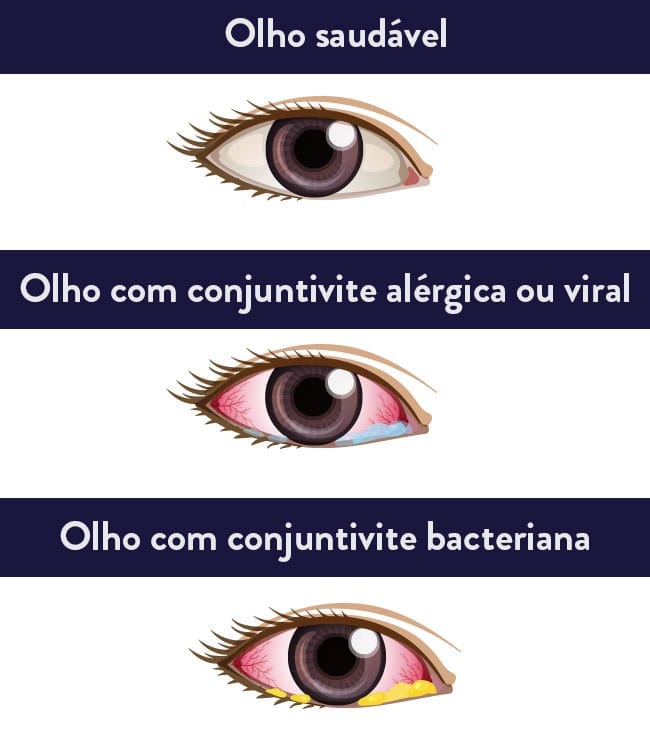 Conjuntivite: saiba os tipos, sintomas e como tratar | Lenscope