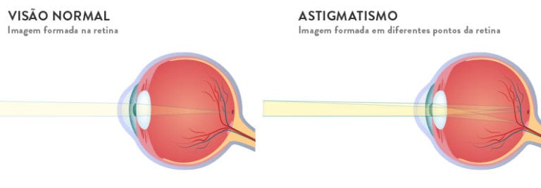 miopia e astigmatismo juntos