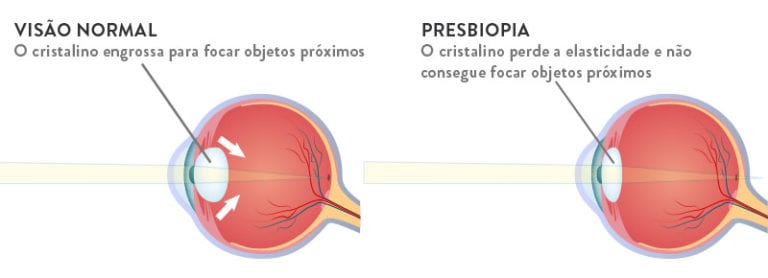 diferença entre miopia hipermetropia astigmatismo e presbiopia