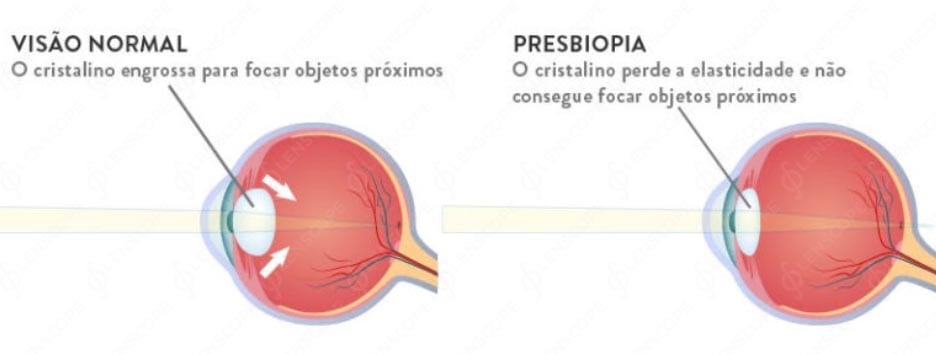 usturimi de ochi si lacrimare viziune restabilită cu astigmatism