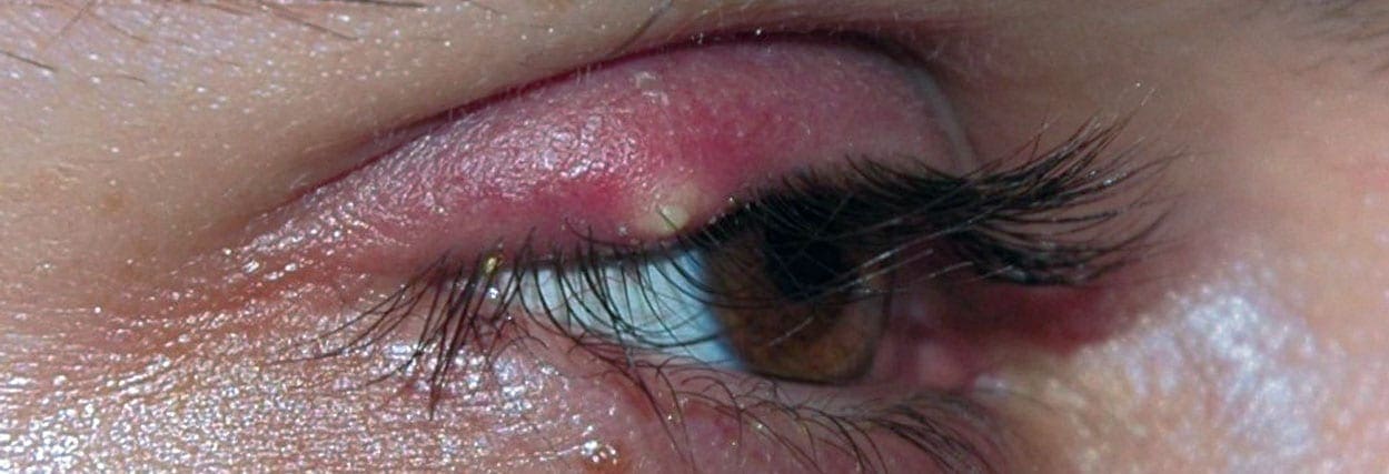 Terçol no olho: o que fazer? | Lenscope