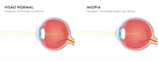 miopia falsa ce va vindeca vederea încețoșată