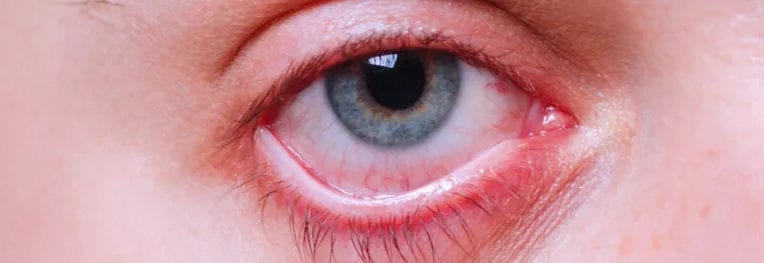 alergias oculares
