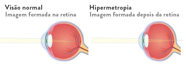 hipermetropia tipo de lente