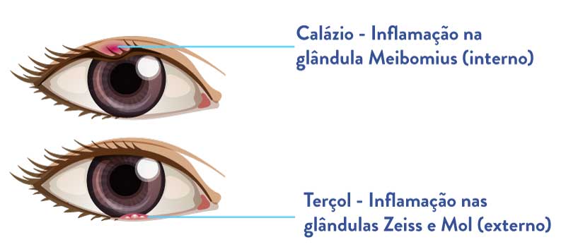 bolinha no olho - calázio ou terçol