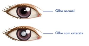 lentes intraoculares preço - olho normal e olho com catarata