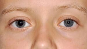 Pupilas anisocóricas