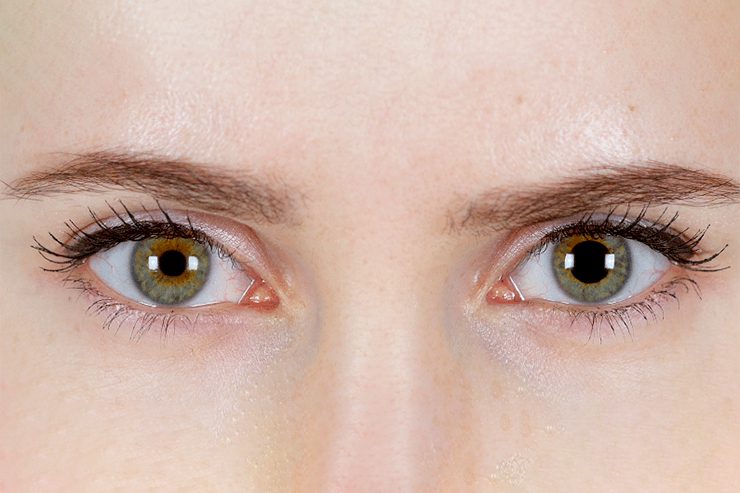Pupilas anisocóricas: o que é anisocoria, causas e tratamentos