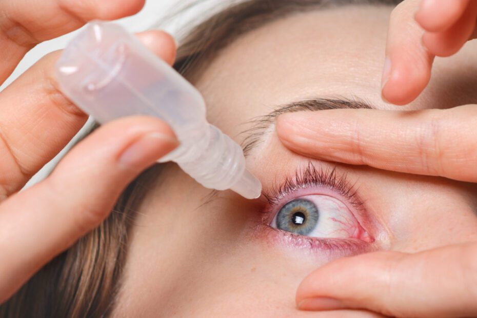 Rosácea ocular: o que é, causas, sintomas e como tratar