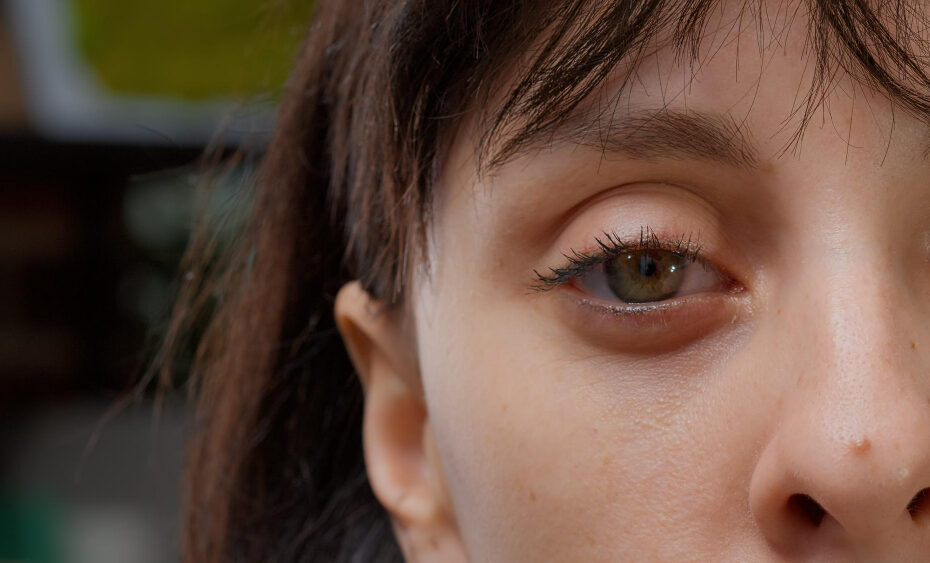 Celulite ocular infantil é uma emergência: entenda o que é, causas e tratamentos