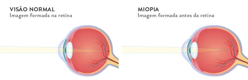 qual a melhor lente de contato para miopia e astigmatismo
